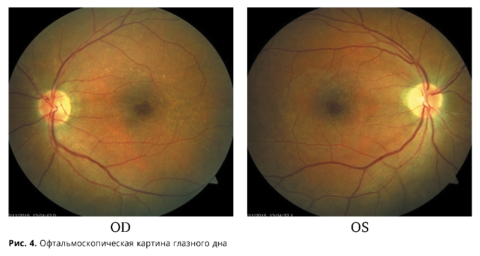 Норма глазного дна. Синдром Фогта-Коянаги-Харады. Офтальмоскопическая картина глазного дна.