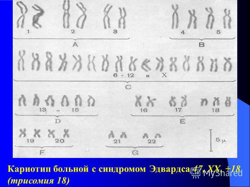 Кариотип дауна. Трисомия Эдвардса кариотип. Кариотип больного с синдромом трисомии - х:.