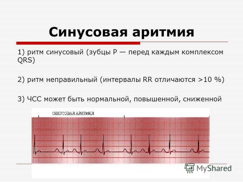 Что значит синусовый ритм сердца на экг. Синусовая аритмия с ЧСС. Синусовая аритмия с ЧСС 80-100 уд/мин. Синусовая аритмия на ЭКГ. Синусовая аритмия ЧСС 67.