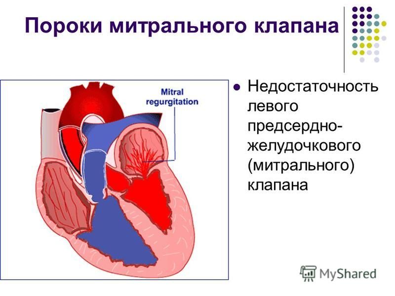 Поражение митрального клапана. Пороки сердца недостаточность митрального клапана. Пороки сердца стеноз митрального клапана. Недостаточность митрального клапана структура. Ревматизм недостаточность митрального клапана.