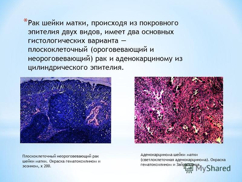 Плоскоклеточная метаплазия что это значит у женщин