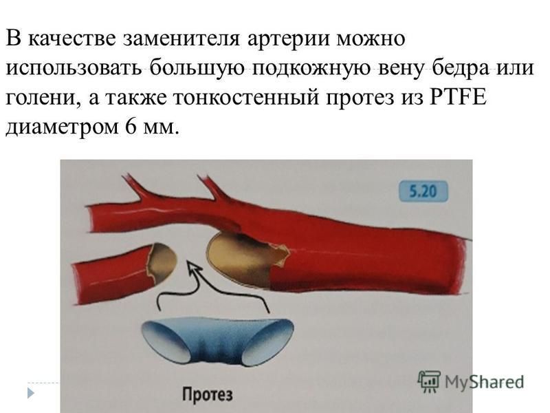 Тромбоэмболия аорты