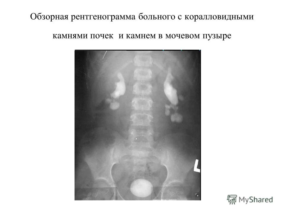 Обзорная рентгенография. Обзорная урография камни в почках. Обзорная урограмма почек рентген. Обзорная рентгенография урография. Камень почки на обзорной рентгенограмме.