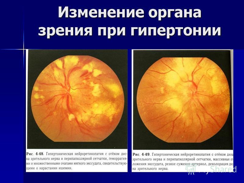 Изменение на глазном дне. Опухоли зрительного нерва глазное дно. Отечный диск зрительного нерва. Изменения глазного дна при гипертонической болезни. Гипертоническая болезнь изменения на глазном дне.