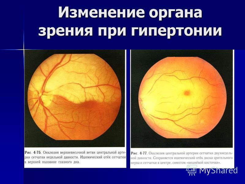 Изменение на глазном дне. Офтальмоскопия глазного дна при гипертонической болезни. Исследование глазного дна при гипертонии 2 степени. Изменения на глазном дне. Изменения на глазном дне при гипертонической болезни.