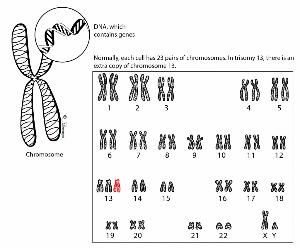 Пересадка хромосом. Синдром Патау трисомия хромосомы 13. Синдром Патау хромосомная карта. Транслокационная форма синдрома Патау кариотип. Кариотип человека при синдроме Патау.
