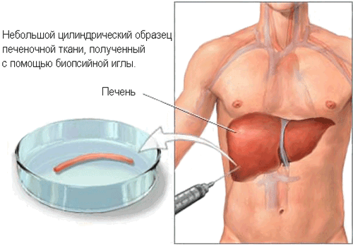 Биопсия печени