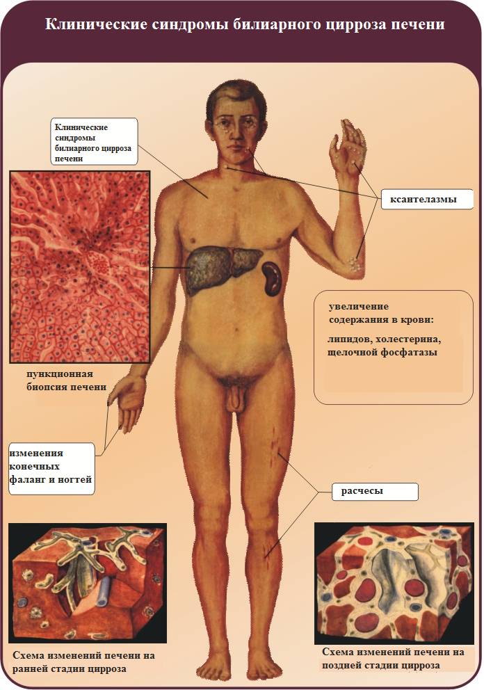 Клинические синдромы билиарного цирроза печени
