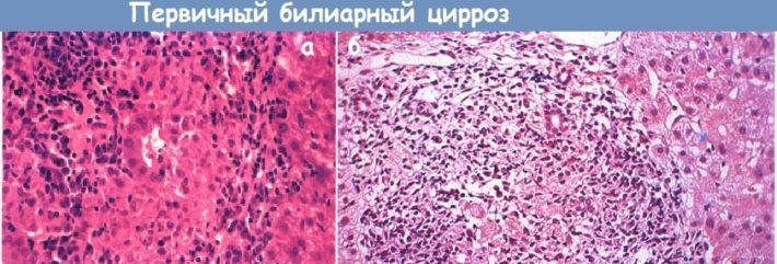 Первичный билиарный цирроз