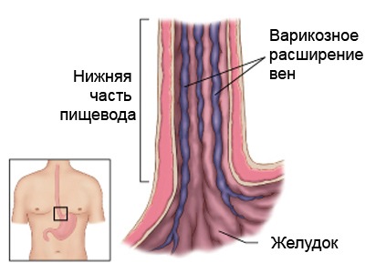 Варикозное расширение вен пищевода