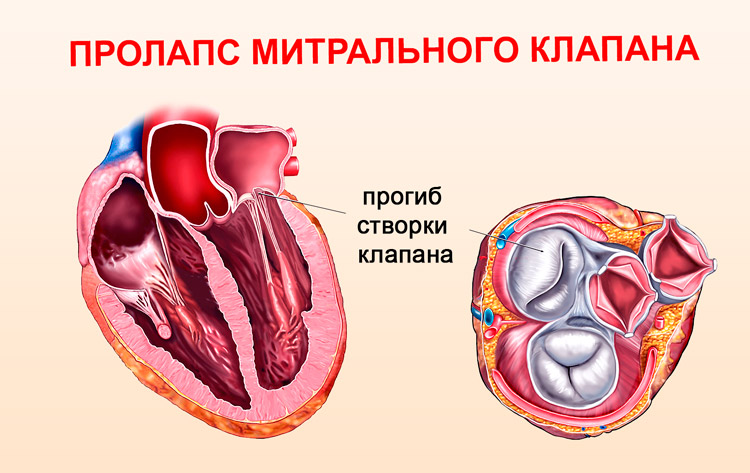 Пролапс митрального клапана