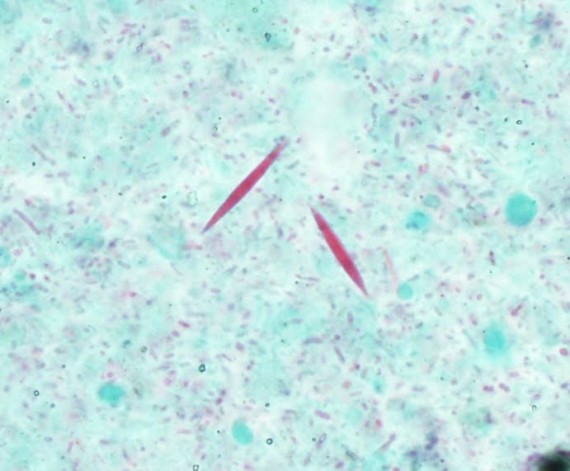 Charcot Lyden Crystals - Trichrome Stain - x400 magnification