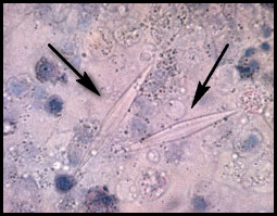 Sputum with Charcot-Leyden crystals in a patient with bronchial asthma
