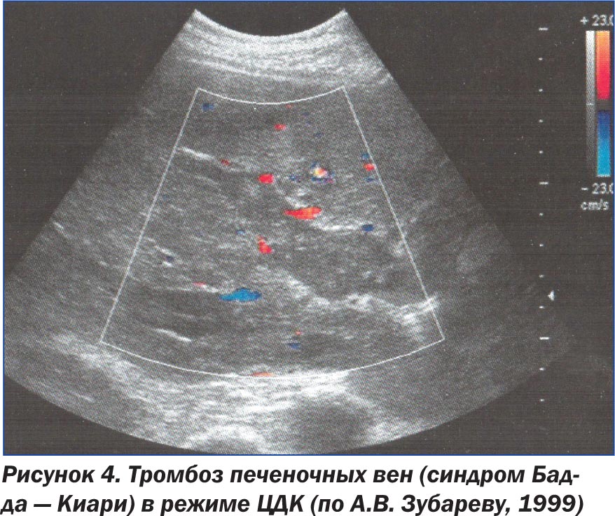 Тромбоз брюшной полости. Тромбоз портальной вены УЗИ. Допплерография воротной вены.