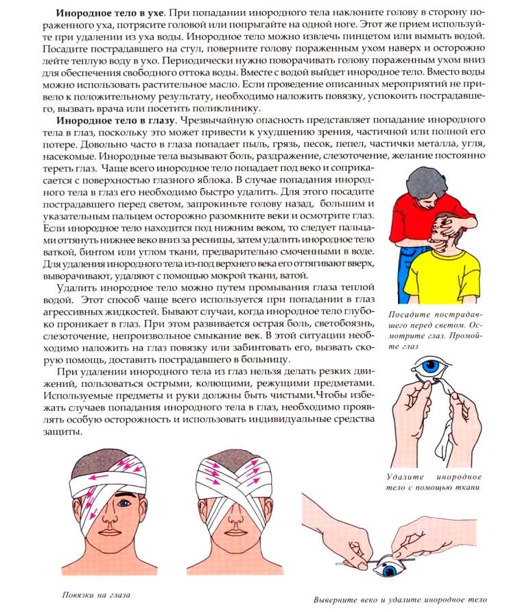 Удаление инородного тела из глаза. Первая помощь при попадании инородного. Оказание первой помощи при попадании инородного тела в глаз. При попадании инородного тела в глаз. Попадание инородных тел в глаза, уши.