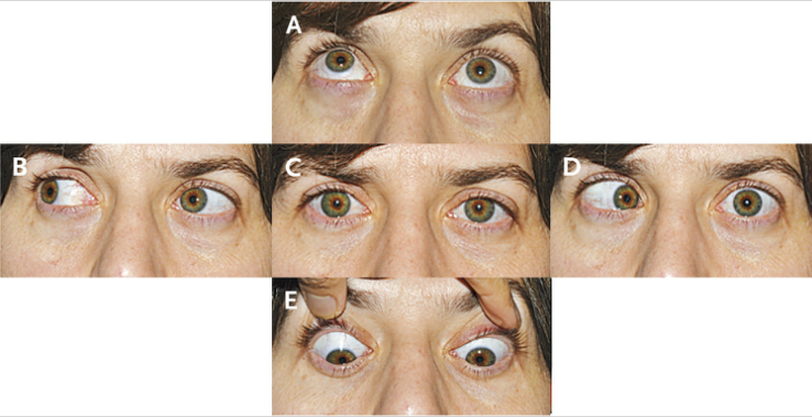 Жалобы на двоение в глазах. Бинокулярная диплопия. Бинокулярная диплопия причины. Двоение в глазах диплопия. Нарушение зрения диплопия.