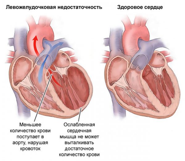 Сердечная недостаточность