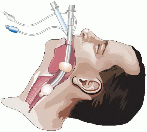 Трубка во время операции. Интубация трахеи наркоз. Анестезия: эндотрахеальный наркоз.. Интубация оксигенотерапия. Интубация трахеи через горло.