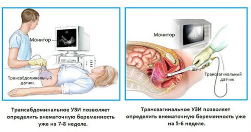 Виды УЗИ малого таза