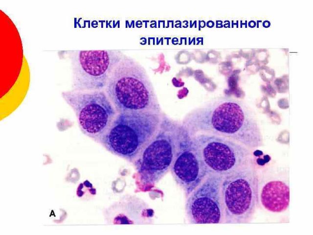 Клетки метаплазированного эпителия