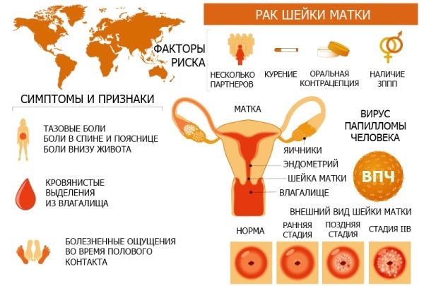 Симптомы рака шейки матки