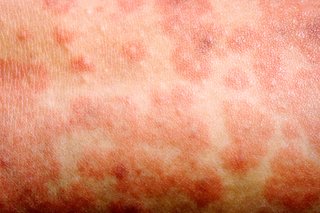 Close-up picture of a measles rash