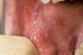Picture of measles spots in the mouth