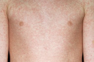 Picture of measles skin rash