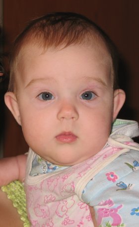 Плоская переносица у ребенка фото