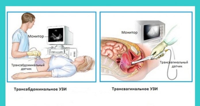 Ультразвуковое исследование на ранних сроках беременности