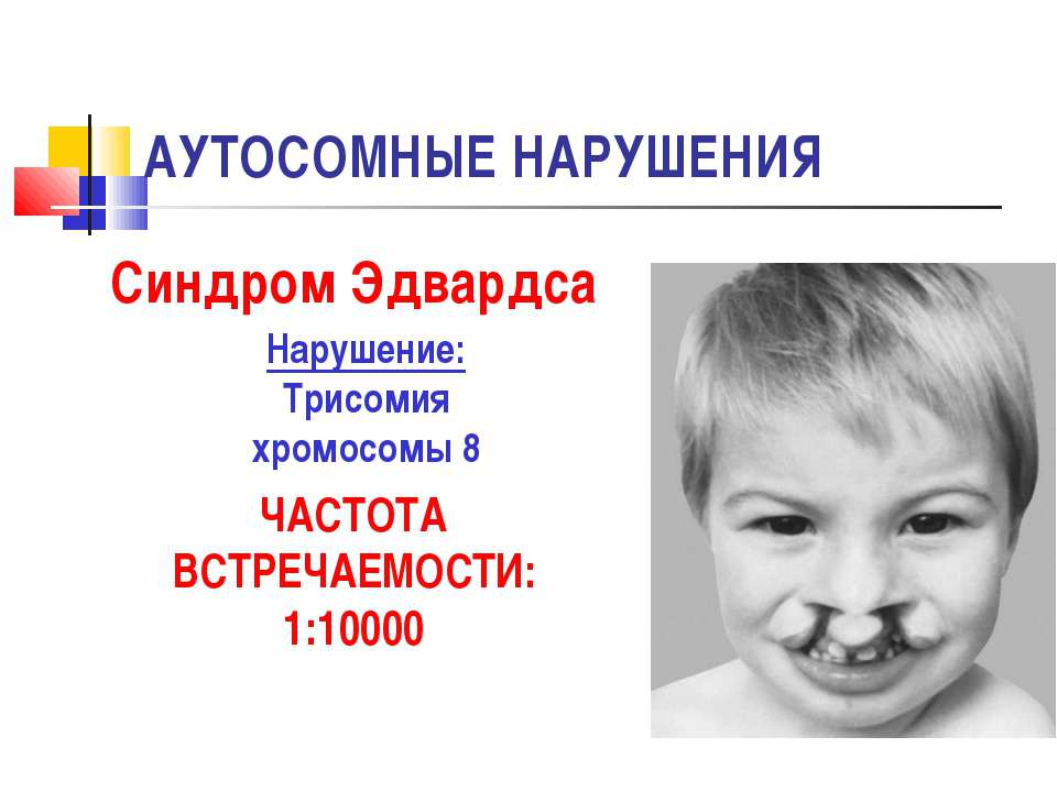 Презентация на тему синдром. Синдром Эдвардса частота встречаемости. Синдром трисомии по 8 хромосоме. Синдром Эдвардса аутосомы.