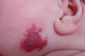 Клубничный невус на щеке младенца