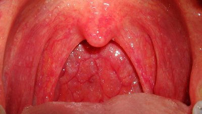 Красное горло - один из симптомов гранулематоза