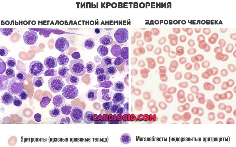 кроветврение при мегалобластной анемии