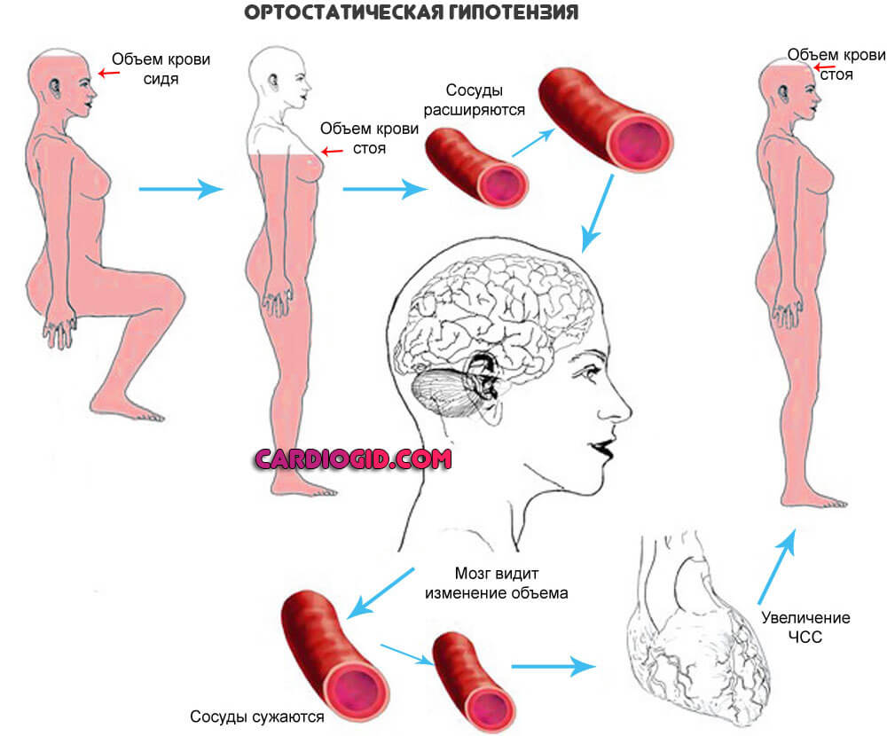 ортостатическая-гипотензия