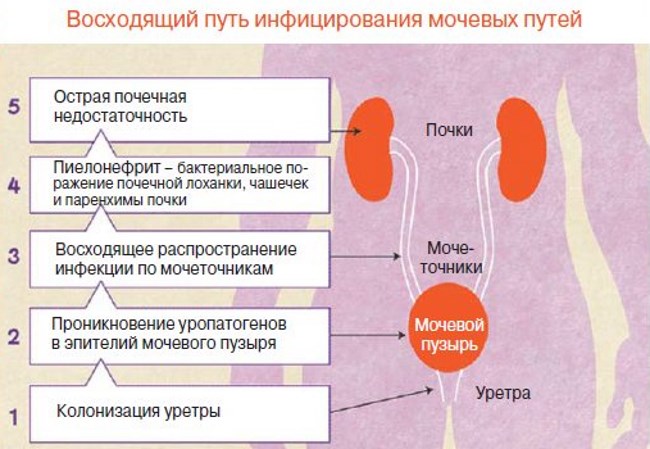 После полового акта через. Симптомы инфекции мочевыделительной системы. Восходящий путь инфекции мочевой. Инфекционные заболевания мочеполовой системы у женщин. Заболевания мочевыделительной системы цистит.