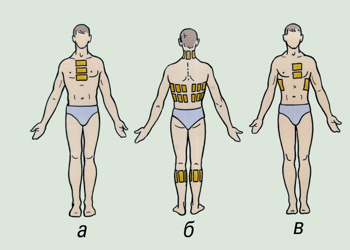 Рис. 1. Схема наложения горчичников на передней (а, в) и задней (б) поверхностях тела
