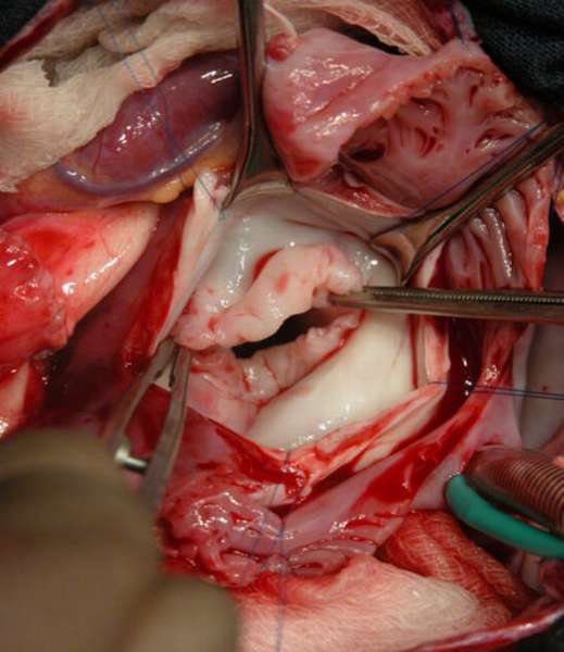 Малоинвазивная операция на сердце по замене клапана – обзор, реабилитация