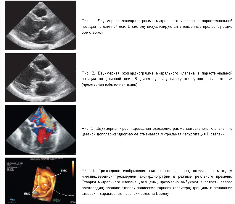 Миксоматозная дегенерация створок клапана. Миксоматозная дегенерация митрального клапана на УЗИ. Утолщение створок митрального клапана ЭХОКГ. Миксоматозная дегенерация ЭХОКГ.