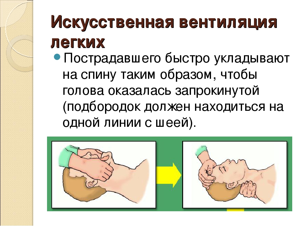 Частота проведения искусственной вентиляции легких взрослому. Искусственная вентиляция. Проведение искусственной вентиляции легких. Техника проведения искусственной вентиляции. Порядок проведения искусственной вентиляции легких.