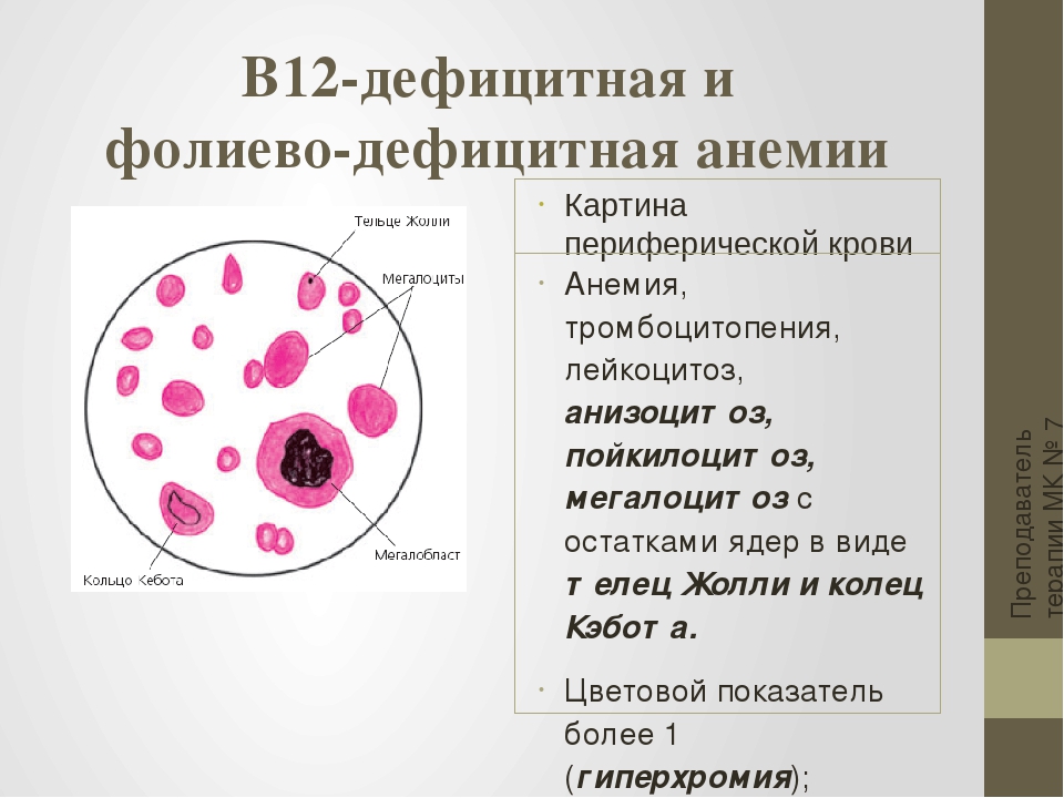 Анемия в моче. Б12 дефицитная анемия мазок крови. В 12 анемия и фолиеводефицитная анемия. В12 фолиеводефицитная анемия картина крови. Витамин в12 и фолиево-дефицитная анемия.