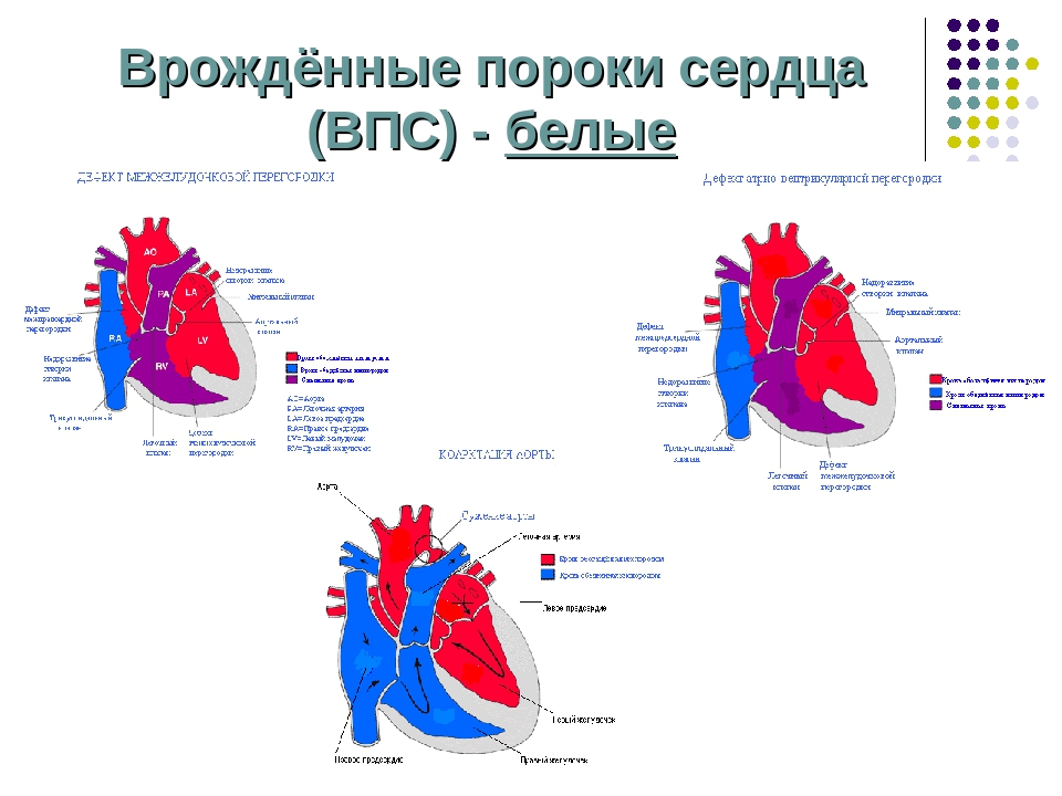 Пороки сердца впс