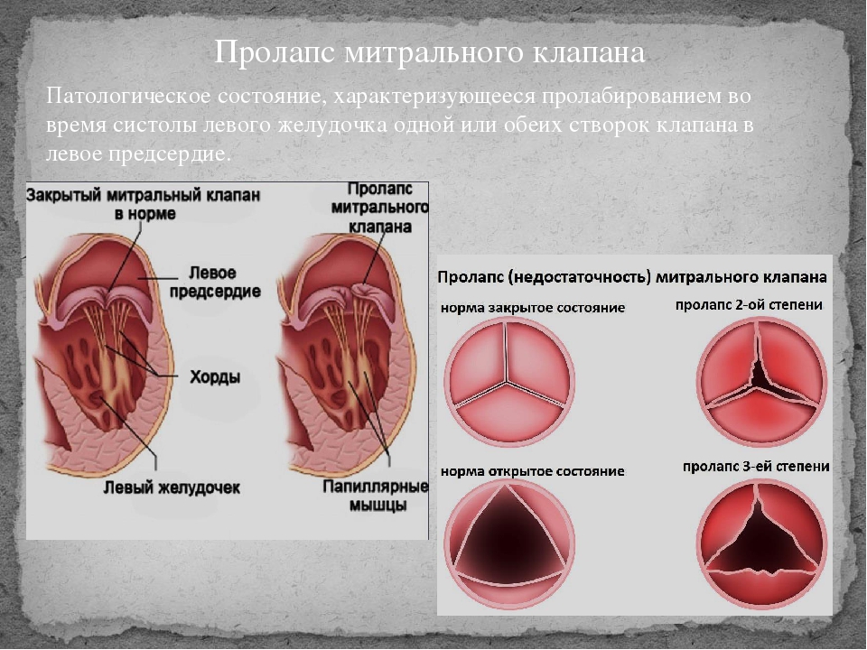 Пролапс. Пролапс передней створки митрального клапана. Пролапс створки митрального клапана. ПРОПАКС мистральрооо клапана. Пролапс передней створки митрального клапана степени.