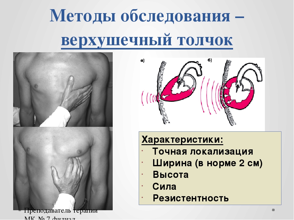 Определить толчок. Верхушечный толчок сердца в норме определяется. Верхушечный толчок пальпируется в 5 межреберье. Методика пальпации верхушечного толчка. Локализация верхушечного толчка в норме.