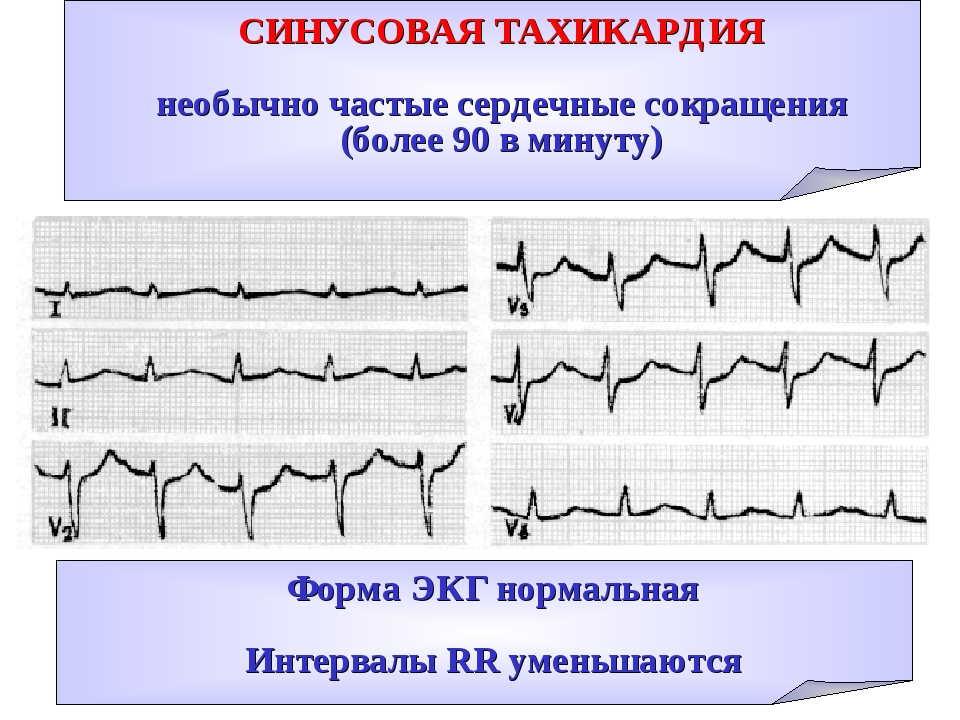 Синусовая тахикардия что это. Синусовая тахикардия причины. Клинические проявления синусовой тахикардии. Синусовая тахикардия терапия. Последствия синусовой тахикардии.