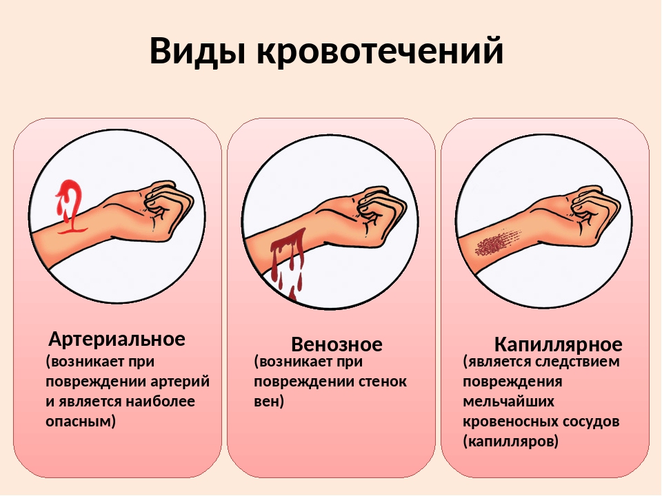 Различные кровотечения. Капиллярное артериальное венозное капиллярное кровотечение. Оказание первой помощи при капиллярном кровотечении. Первая помощь при артериальном венозном и капиллярном кровотечении. Копилярноекровотечение.