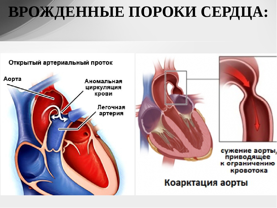 Что такое порок. Врожденный порок сердца (ВПС). Врожденные клапанные пороки сердца. Ревматизм пороки сердца. Врожденныепопроки сердца.