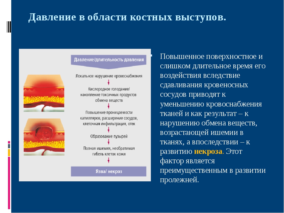 Цель пролежней. Причины возникновения пролежней. Механизм развития пролежней. Механизм образования пролежней.