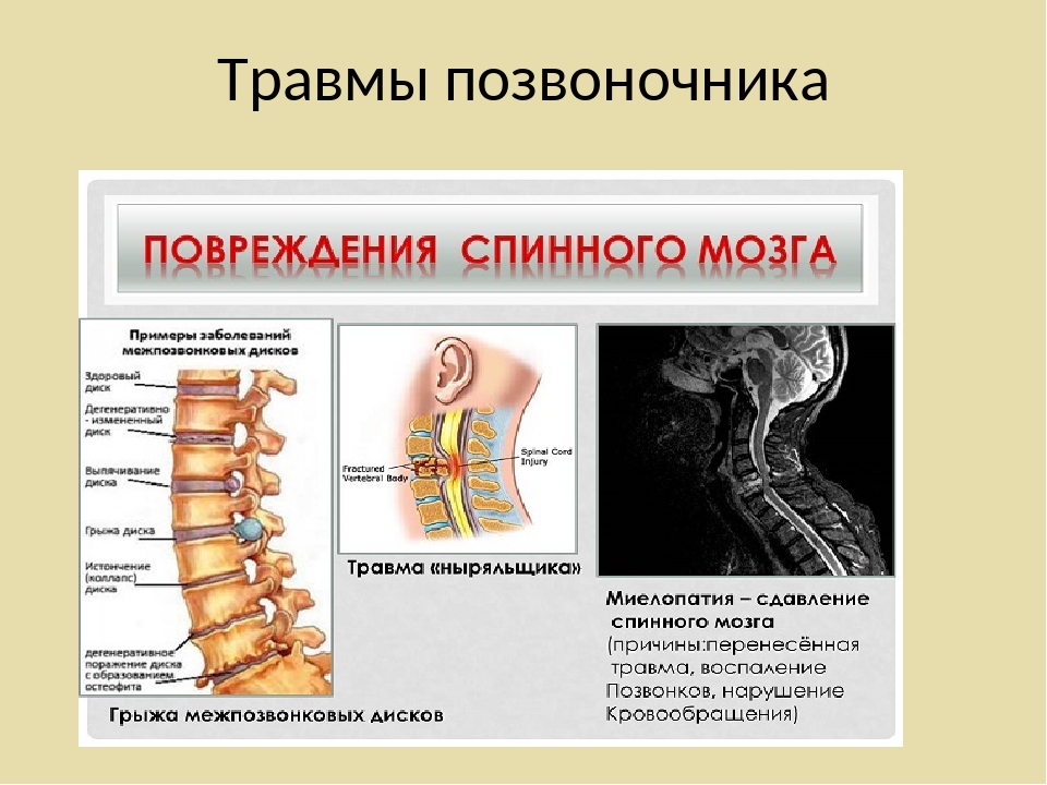 Травмы позвоночника с повреждением. Повреждение спинного мозга. Заболевания и травмы спинного мозга. Причины повреждения спинного мозга.