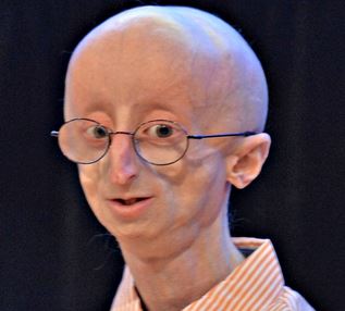 progeria syndrome picture